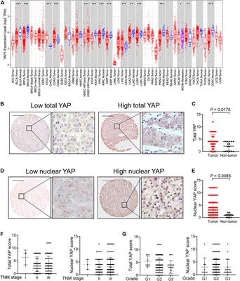 Oncogenic Activation of YAP Signaling Sensitizes Ferroptosis of Hepatocellular Carcinoma via ALOXE3-Mediated Lipid Peroxidation Accumulation